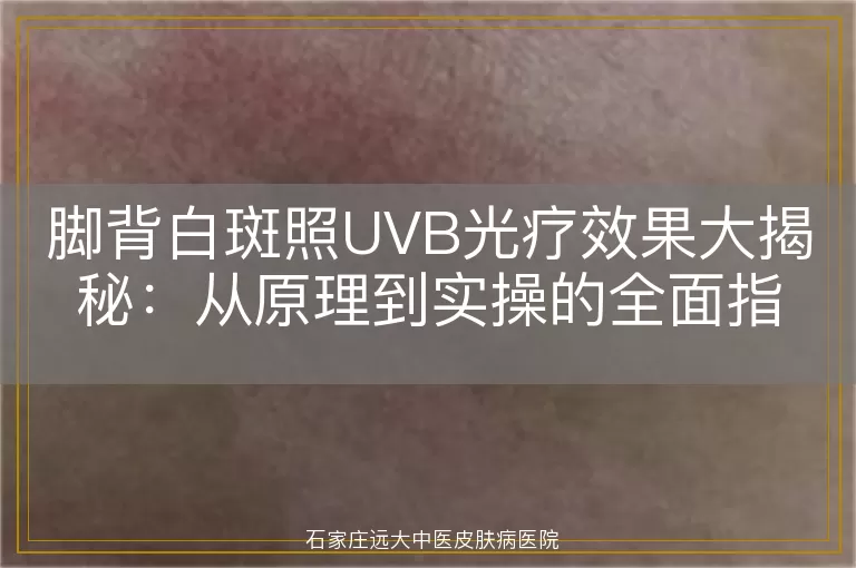 脚背白斑照UVB光疗效果大揭秘：从原理到实操的全面指南