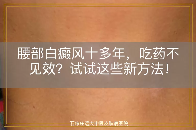 腰部白癜风十多年，吃药不见效？试试这些新方法！
