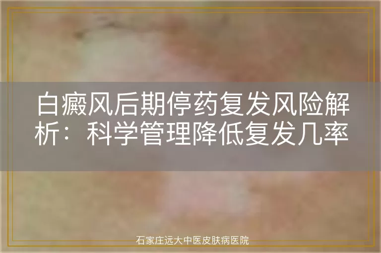 白癜风后期停药复发风险解析：科学管理降低复发几率