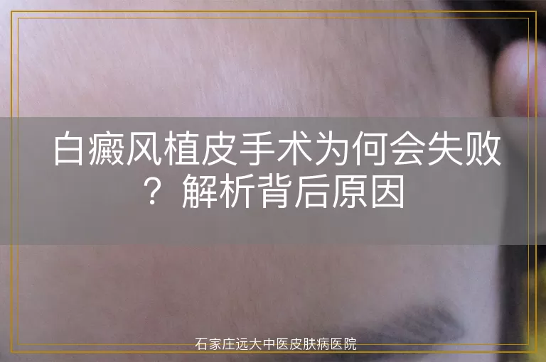 白癜风植皮手术为何会失败？解析背后原因