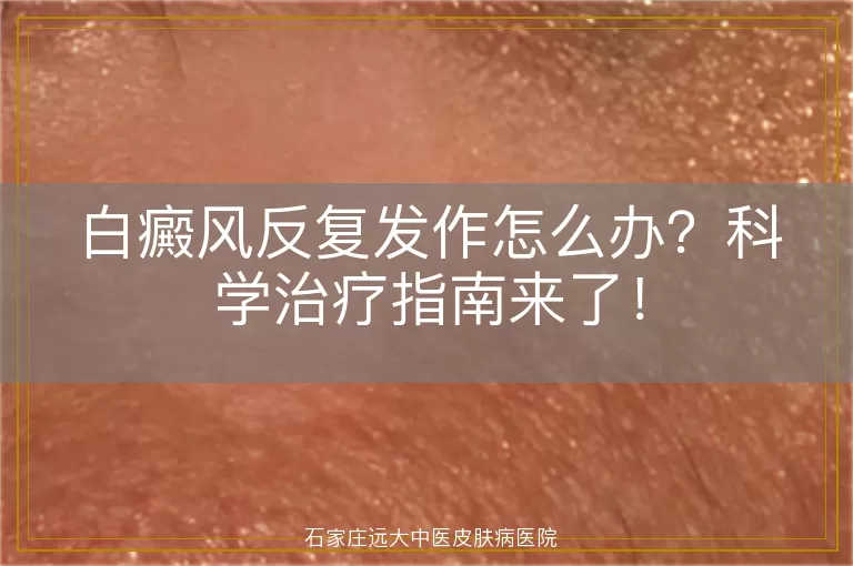 白癜风反复发作怎么办？科学治疗指南来了！