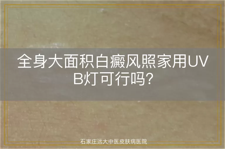 全身大面积白癜风照家用UVB灯可行吗？