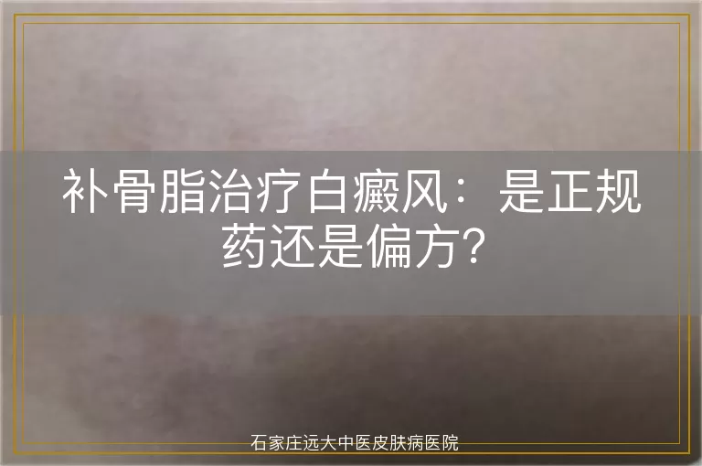 补骨脂治疗白癜风：是正规药还是偏方？