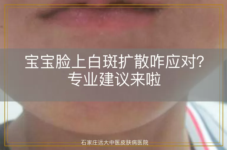 宝宝脸上白斑扩散咋应对？专业建议来啦