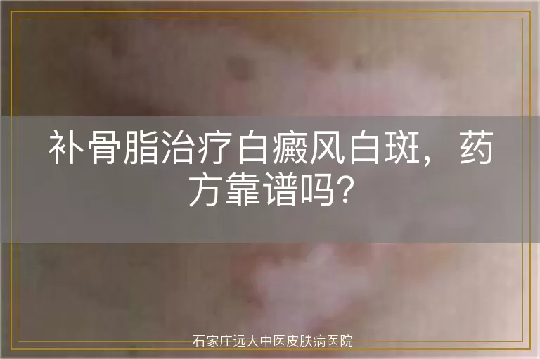 补骨脂治疗白癜风白斑，药方靠谱吗？