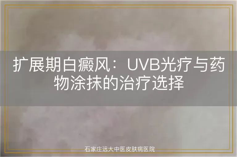 扩展期白癜风：UVB光疗与药物涂抹的治疗选择