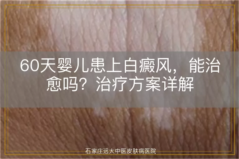 60天婴儿患上白癜风，能治愈吗？治疗方案详解