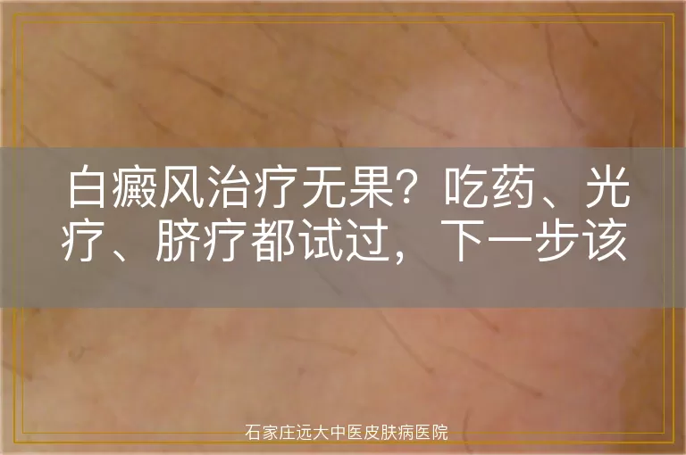 白癜风治疗无果？吃药、光疗、脐疗都试过，下一步该怎么走？