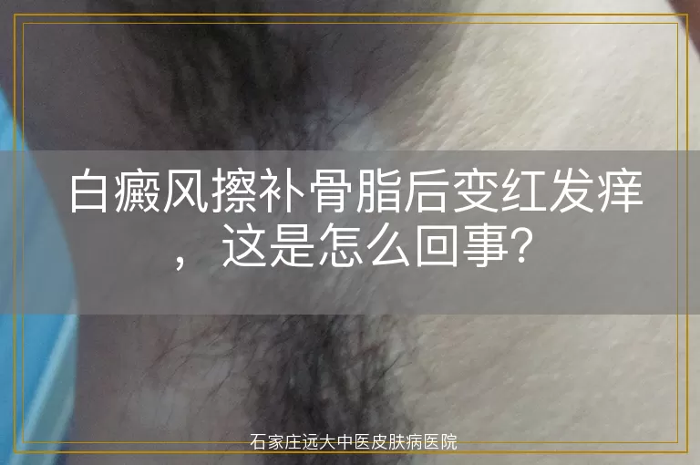白癜风擦补骨脂后变红发痒，这是怎么回事？