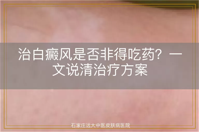 治白癜风是否非得吃药？一文说清治疗方案