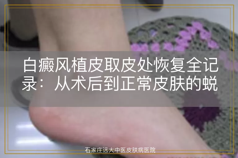 白癜风植皮取皮处恢复全记录：从术后到正常皮肤的蜕变过程