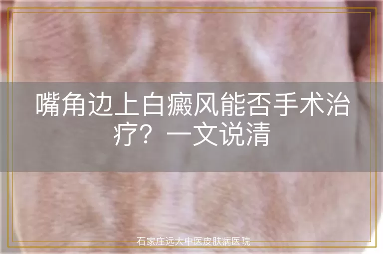 嘴角边上白癜风能否手术治疗？一文说清