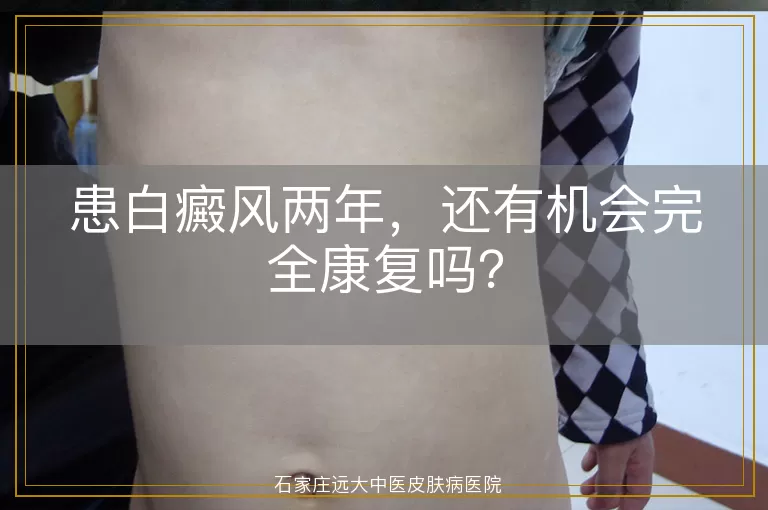 患白癜风两年，还有机会完全康复吗？