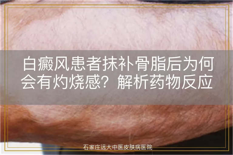 白癜风患者抹补骨脂后为何会有灼烧感?解析药物反应与应对方法