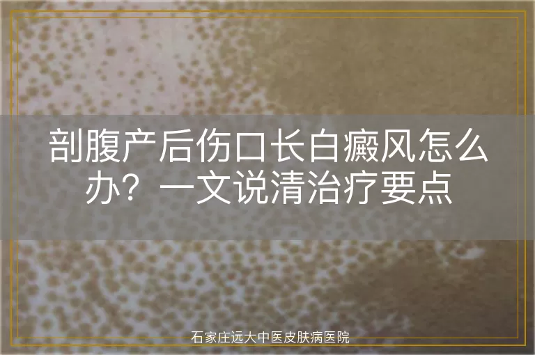 剖腹产后伤口长白癜风怎么办?一文说清治疗要点