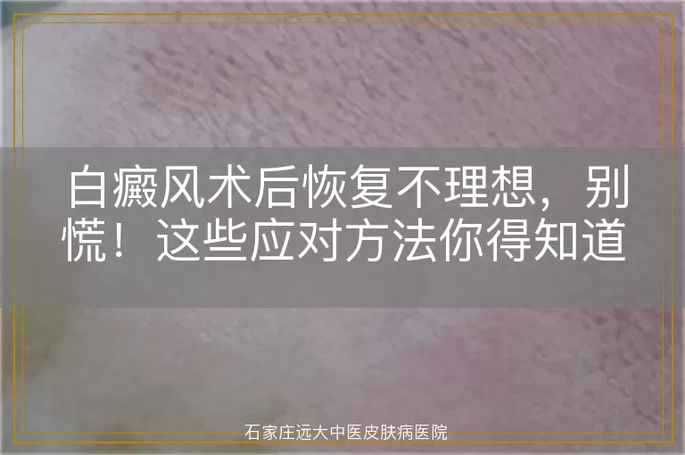 白癜风术后恢复不理想，别慌！这些应对方法你得知道