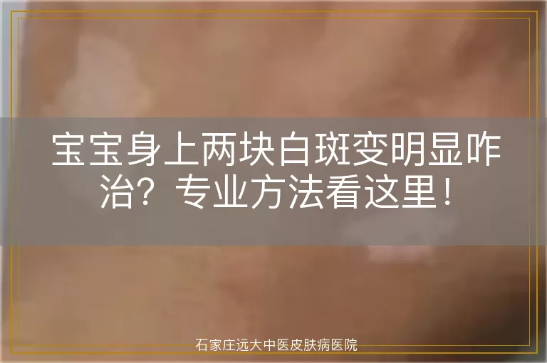 宝宝身上两块白斑变明显咋治？专业方法看这里！