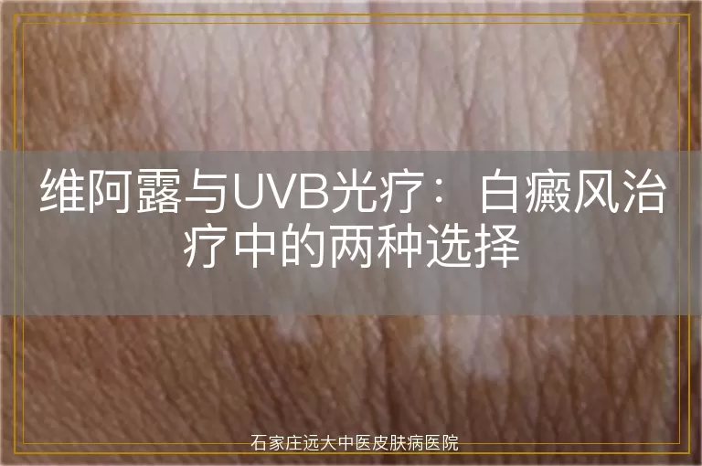 维阿露与UVB光疗：白癜风治疗中的两种选择