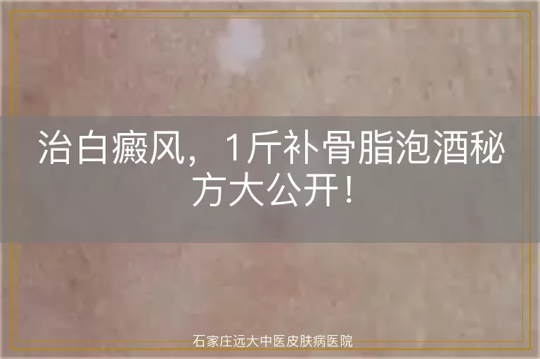 治白癜风，1斤补骨脂泡酒秘方大公开！