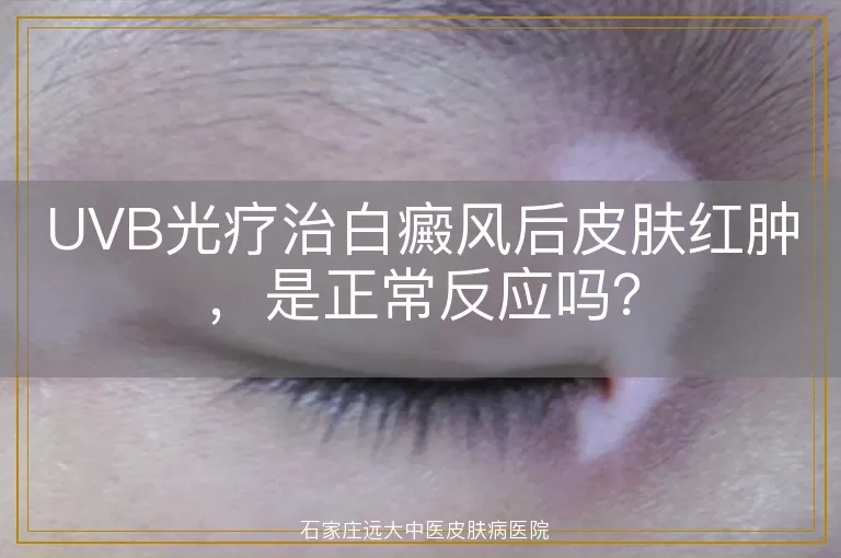 UVB光疗治白癜风后皮肤红肿，是正常反应吗？