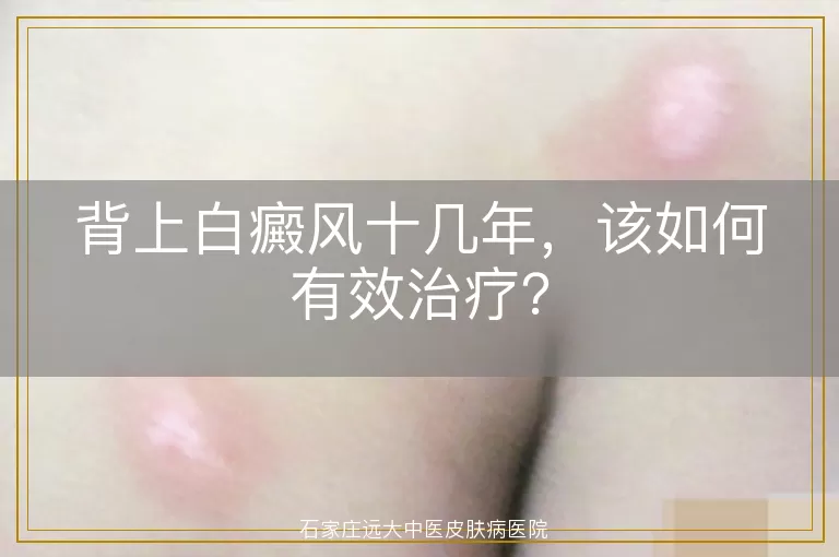 背上白癜风十几年，该如何有效治疗？