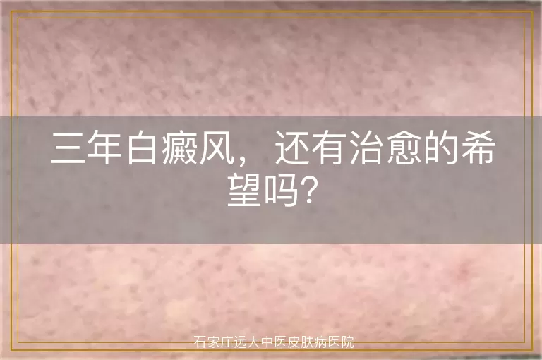 三年白癜风，还有治愈的希望吗？