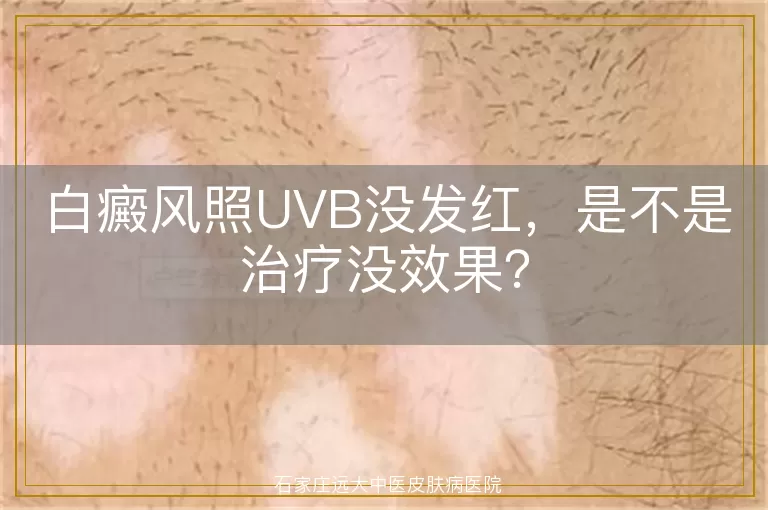 白癜风照UVB没发红，是不是治疗没效果？