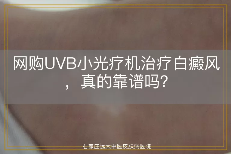 网购UVB小光疗机治疗白癜风，真的靠谱吗？