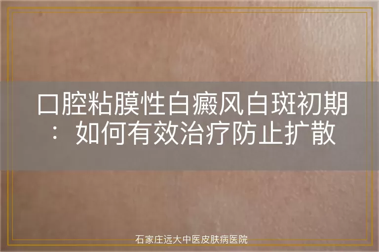 口腔粘膜性白癜风白斑初期：如何有效治疗防止扩散