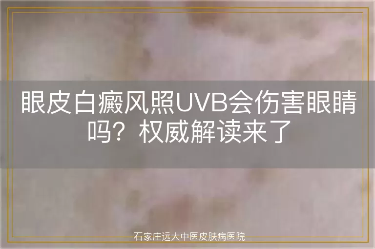 眼皮白癜风照UVB会伤害眼睛吗？权威解读来了