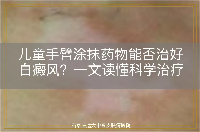 儿童手臂涂抹药物能否治好白癜风？一文读懂科学治疗方案