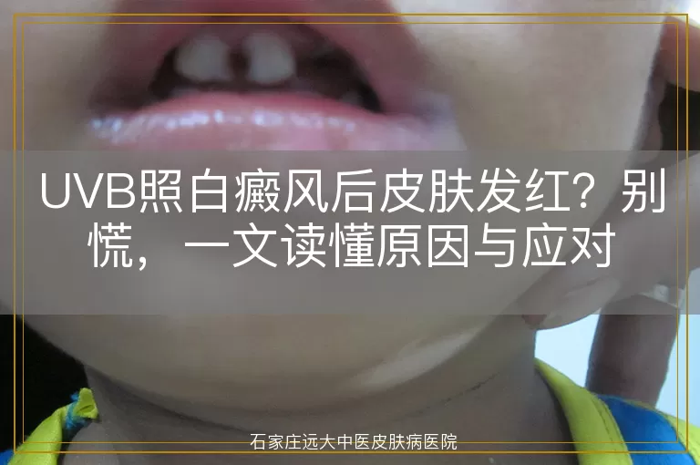 UVB照白癜风后皮肤发红？别慌，一文读懂原因与应对