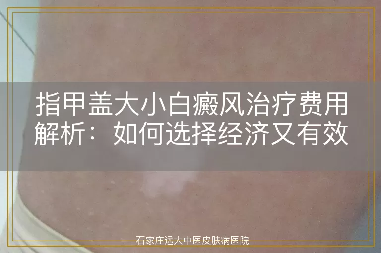 指甲盖大小白癜风治疗费用解析：如何选择经济又有效的方案？