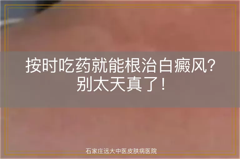 按时吃药就能根治白癜风？别太天真了！