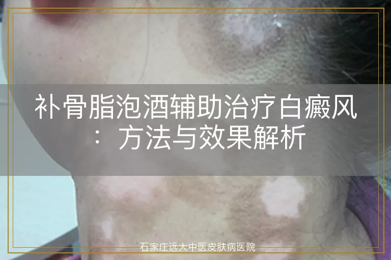 补骨脂泡酒辅助治疗白癜风：方法与效果解析