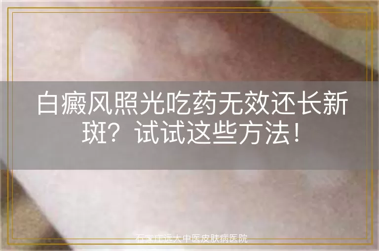 白癜风照光吃药无效还长新斑？试试这些方法！