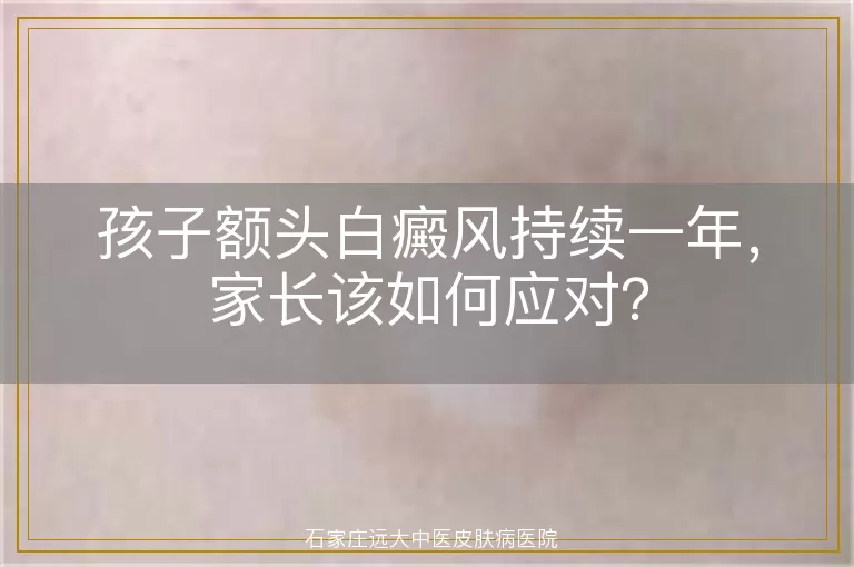 孩子额头白癜风持续一年，家长该如何应对？