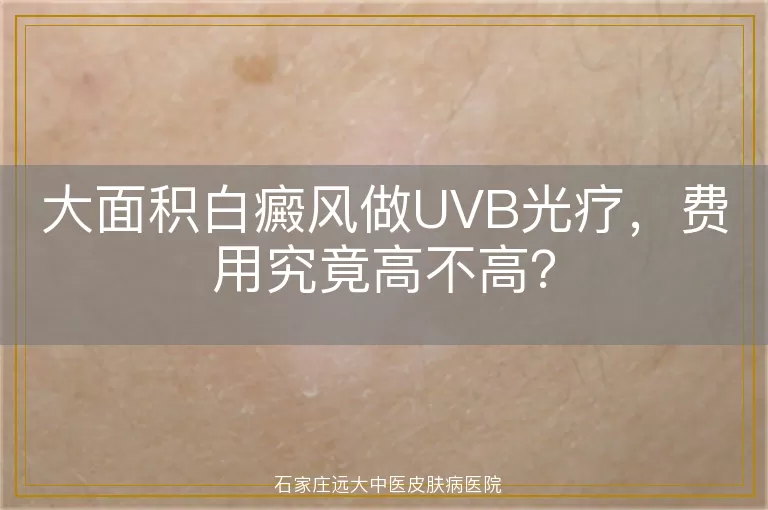 大面积白癜风做UVB光疗，费用究竟高不高？