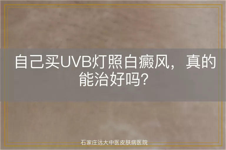 自己买UVB灯照白癜风，真的能治好吗？