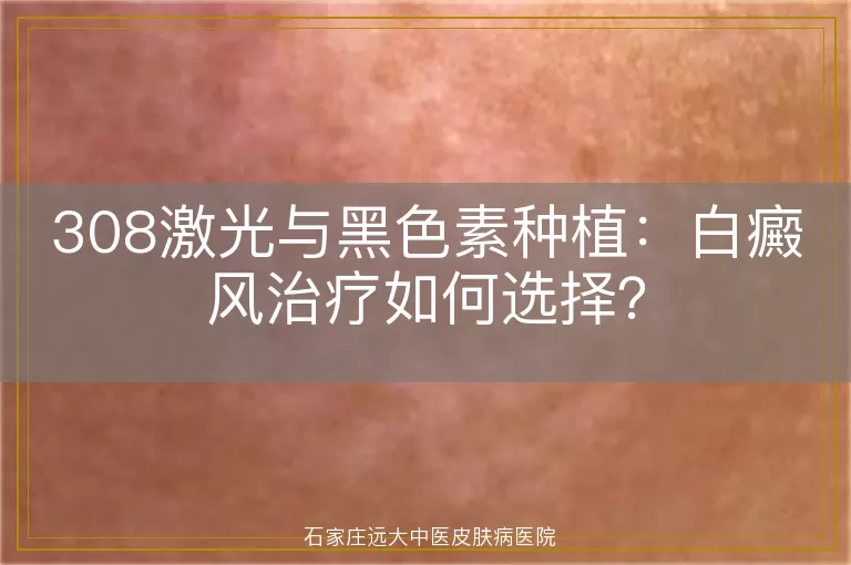 308激光与黑色素种植：白癜风治疗如何选择？