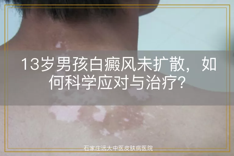 13岁男孩白癜风未扩散，如何科学应对与治疗？