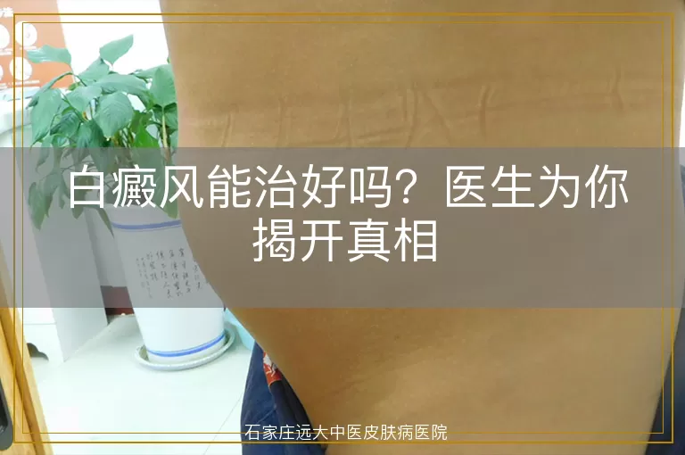 白癜风能治好吗？医生为你揭开真相