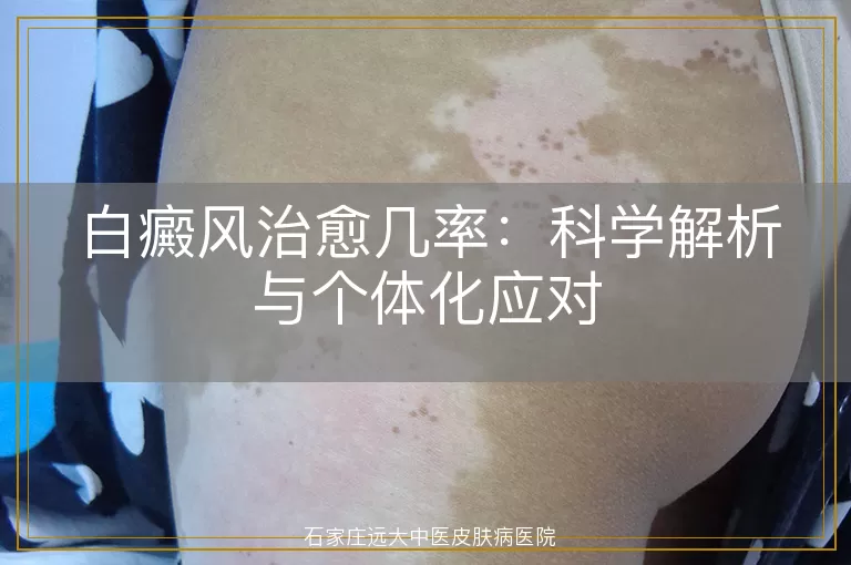 白癜风治愈几率：科学解析与个体化应对