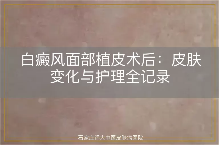 白癜风面部植皮术后：皮肤变化与护理全记录