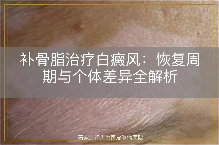 补骨脂治疗白癜风：恢复周期与个体差异全解析