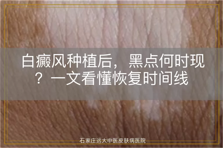 白癜风种植后，黑点何时现？一文看懂恢复时间线