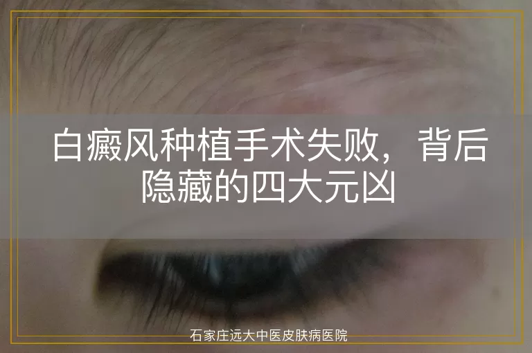 白癜风种植手术失败，背后隐藏的四大元凶