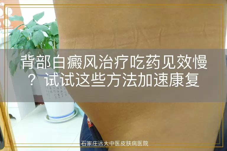 背部白癜风治疗吃药见效慢？试试这些方法加速康复