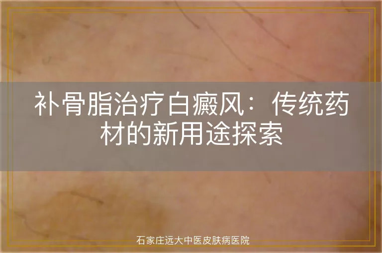 补骨脂治疗白癜风：传统药材的新用途探索