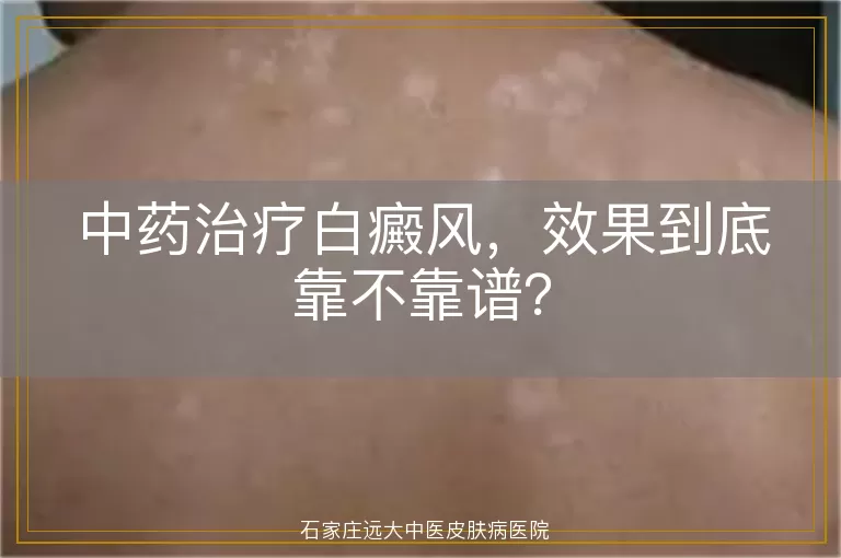 中药治疗白癜风，效果到底靠不靠谱？